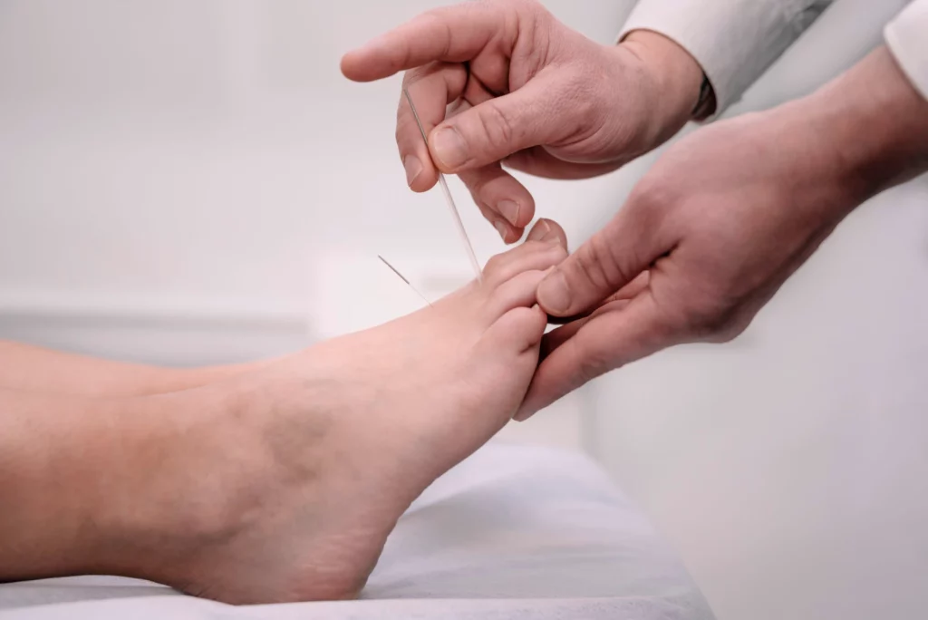 close up of hands placing acupuncture needles in p 2023 11 27 05 15 22 utc